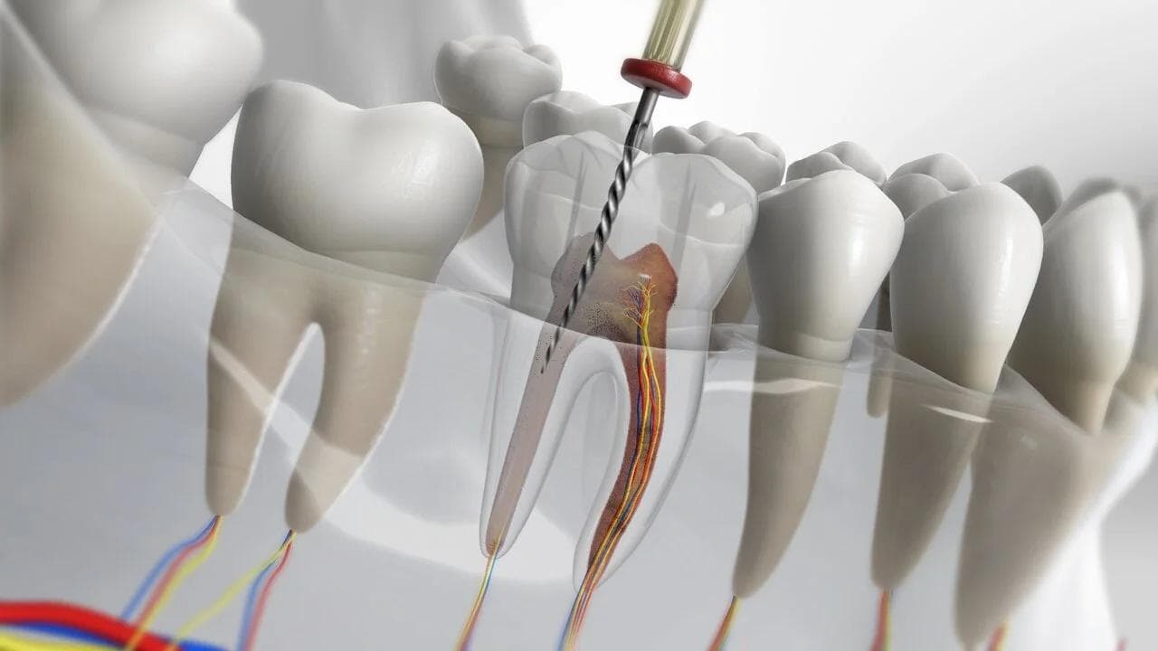 Endodonție (Tratament canal)