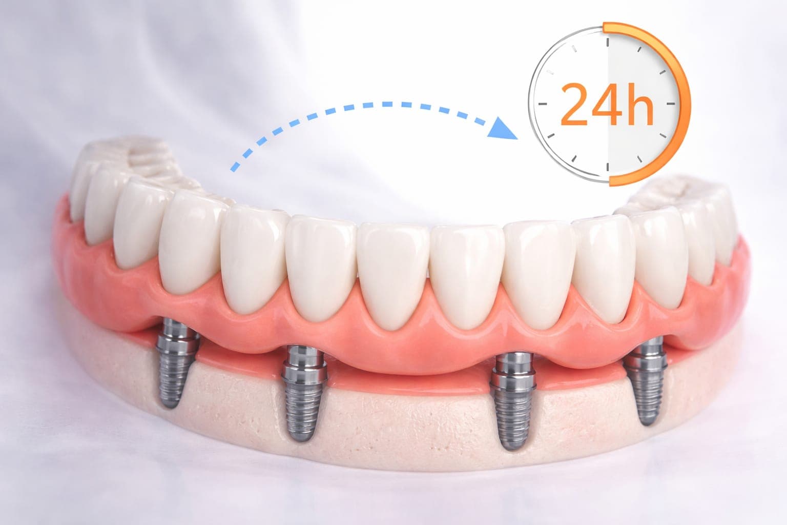Dinți ficsi în 24h